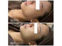 キンキー(Kinky)の雰囲気（敏感肌、ニキビケア。）