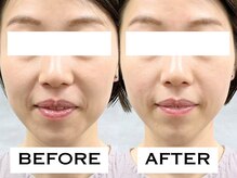 ビハリスト 新宿南口/ほうれい線が改善！