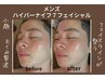 初回【メンズ限定】小顔リフトアップ・美肌★ハイパーナイフフェイシャル60分