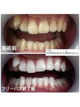 ホワイトニングサロン 京都烏丸店/ホワイトニング施術例
