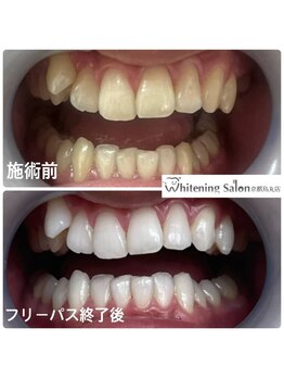 ホワイトニングサロン 京都烏丸店/ホワイトニング施術例