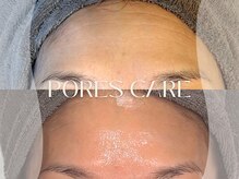 キュレイテッドスキン(CURATED SKIN)/フェイシャル/肌質改善/プラズマ