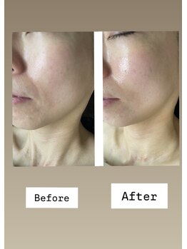 FJ/ホウレイ線改善