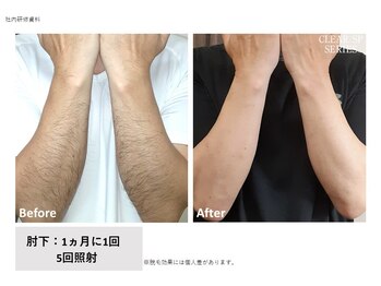 脱毛サロン　ｓｉｍｐｌｅ＋【6月NEW OPEN（予定）】の写真/【完全都度払い専門店】高額コース契約や無理な勧誘なし！お財布に優しい価格設定で美容室感覚で通える♪