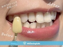 ホワイトニングカフェ赤羽店/ホワイトニングビフォーアフター