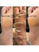 リノア(Linoa)/韓国式足裏角質ケア-splaning-