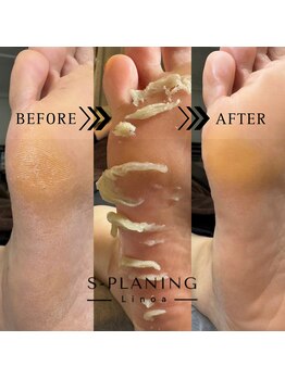 リノア(Linoa)/韓国式足裏角質ケア-splaning-