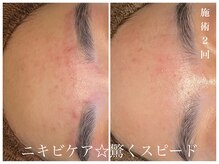 ダン(dan)/陶肌トリートメント【症例】