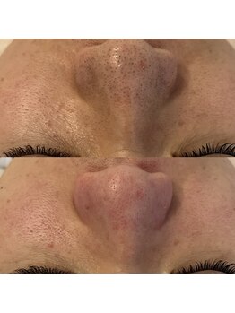 ノイ(Noi.)/Before-After