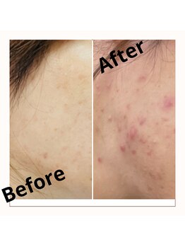 ブロン(Blanc)/肌質改善