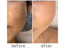 トモズサロン28(Tomos.salon.)/くすみ・シミ改善！