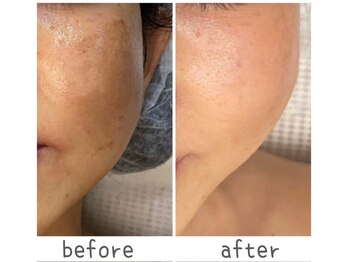 トモズサロン28(Tomos.salon.)/くすみ・シミ改善！