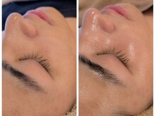 アン(anne)/剥離なしハーブピーリング×3回