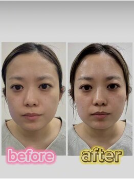 キラビ マリン呉キレイ館(KIRA★美)/フェイス施術