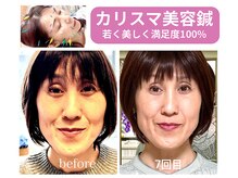 ピーチ鍼灸整体治療院(Peach鍼灸整体治療院)の雰囲気（美容鍼は何歳でも引き締まった、ハリのある顔をつくれます◎）