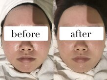 上野エステサロン レア(Lea)/フェイシャル 赤み＆毛穴