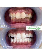 ホワイトニングサロン 名古屋駅店/【ホワイトニング施術例】