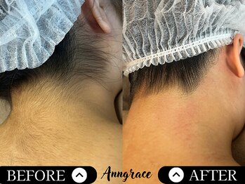 アングレイス(Anngrace)/【全身脱毛うなじ】Before/After