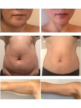 賢者のボディケアの写真/速攻小顔&持続力◎関東で希少!!【レモンボトル×インディバ】同時施術◆厳選高品質&こだわり施術は圧巻!!