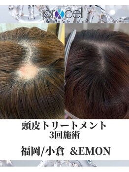 アンドエモン(&EMON)/【頭皮】プロセル効果