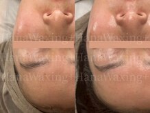 ハナワクシングプラス 高知(HanaWaxing+)/【フェイシャルワックス】