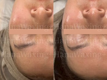 ハナワクシングプラス 高知(HanaWaxing+)/【フェイシャルワックス】