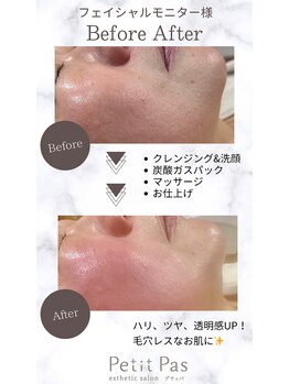 プティパ(Petit Pas)/フェイシャルビフォーアフター