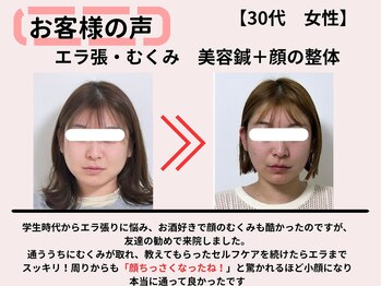 サロンスマイル/30代美容鍼ビフォーアフター