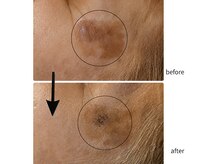 サロン リノ(salon rino)の雰囲気（シミ、ここまで反応。ホワイトラボ1回目気になるシミを狙いうち）