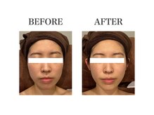 ルアバイアロ(Lua by Alo's)/小顔コース