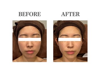 ルアバイアロ(Lua by Alo's)/小顔コース