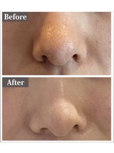 ビ ボーテ(美 Beaute)/毛穴★浮腫！小鼻縮小すっきり♪