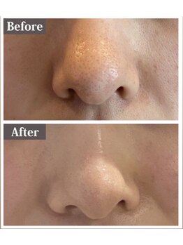 ビ ボーテ(美 Beaute)/毛穴★浮腫!小鼻縮小すっきり♪