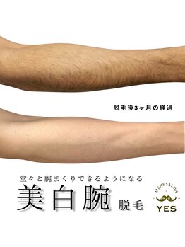 イエス 東京池袋店(YES)/腕脱毛