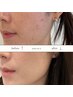 【エステ版ポテンツァ特価】高周波プラズマケア￥23,000 → 17,500