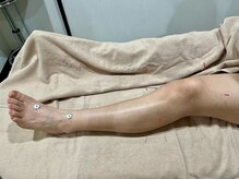 やさしい鍼灸の雰囲気（足のむくみや冷えにやさしいお灸と鍼です。）