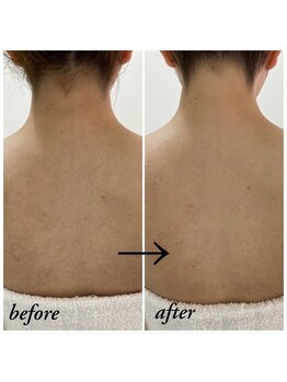 ティアル 赤坂(tiarl)/うなじ~お背中シェービング