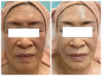 リッツ 草加店(Ritz)/【Before/After】おでこ、眉間