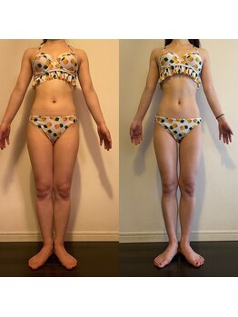 レナトゥス 銀座(Renatus)/BeforeAfter【痩身/東京/銀座】