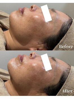 カルナ(CARNA)/フェイスラインの引き上げなら