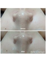 ベルクラージュ(Belle Courage)/20代　毛穴