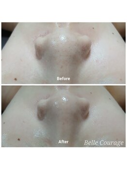 ベルクラージュ(Belle Courage)/20代　毛穴