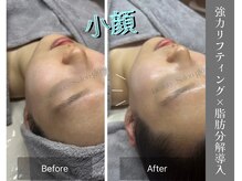 グロウ(glow.)/究極小顔！施術直後Before/After