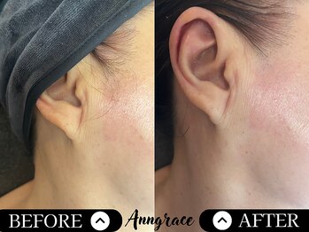 アングレイス(Anngrace)/ブライダル【お顔脱毛もみあげ】