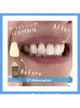 ホワイトニングカフェ 和歌山ガーデンパーク店(WhiteningCafe)/12回照射症例