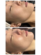 ヴィオラ 松戸店(Viola)/ラフォンテドライピーリング効果