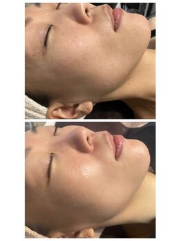 ヴィオラ 松戸店(Viola)/ラフォンテドライピーリング効果