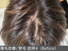 オアシスラグーン(OASIS LAGOON)/育毛促進（症例4 before）