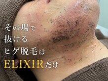 エリクサー 加須店(Elixir)の雰囲気（その場で抜けるヒゲ脱毛はELIXIRだけ！◎）