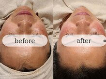 ブラン(BLANC)/【ヒト幹細胞美容】50％濃度導入